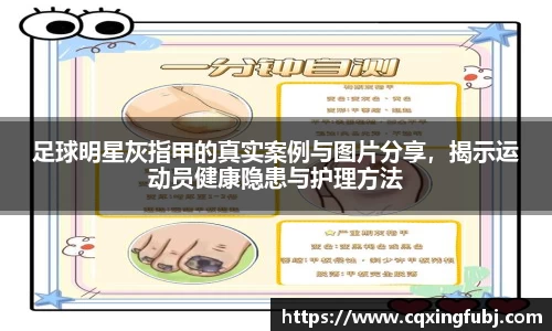足球明星灰指甲的真实案例与图片分享，揭示运动员健康隐患与护理方法